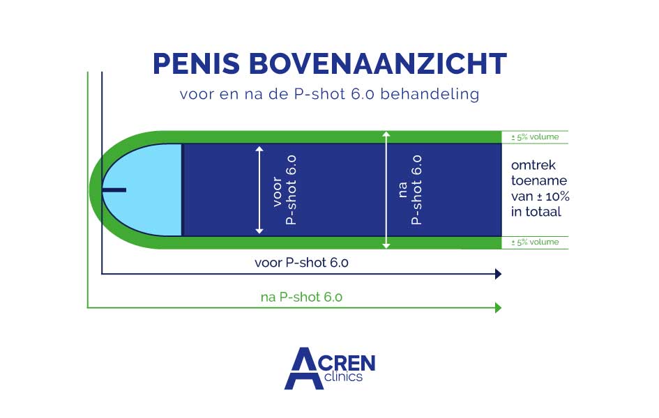 penis verlenging